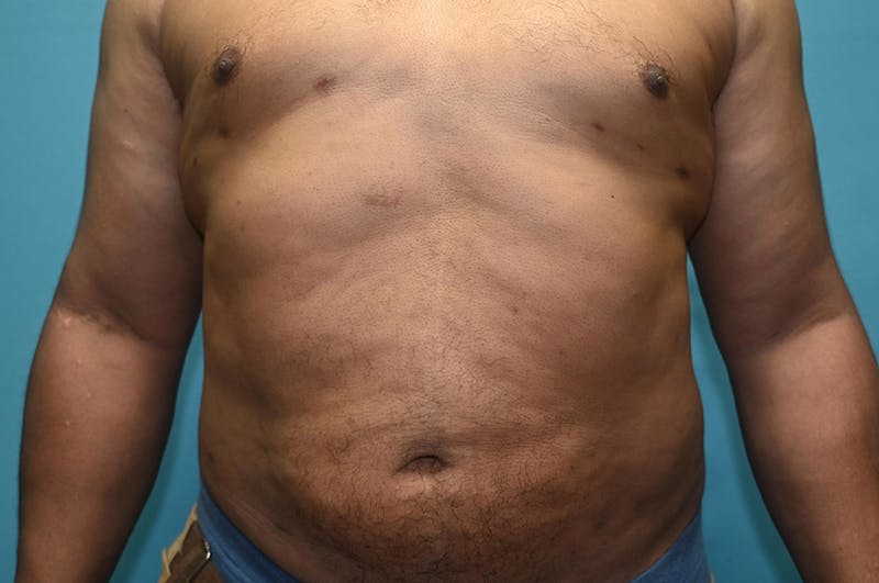 Liposuction Before & After Gallery - Patient 8795248 - Image 2