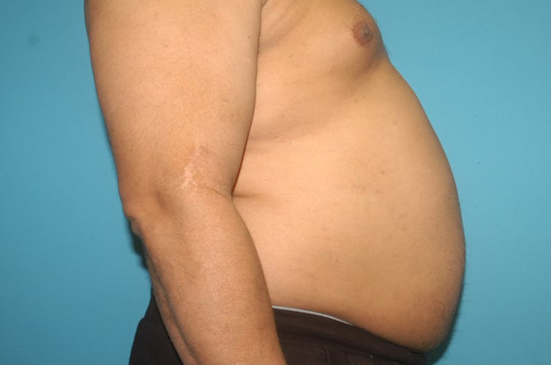 Liposuction Before & After Gallery - Patient 8795248 - Image 3