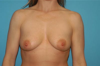 Mastopexy Before & After Gallery - Patient 8795249 - Image 1