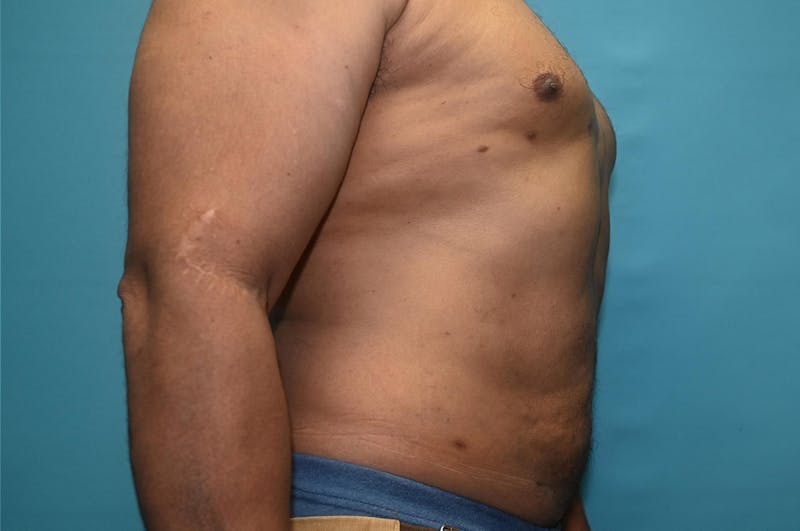 Liposuction Before & After Gallery - Patient 8795248 - Image 4