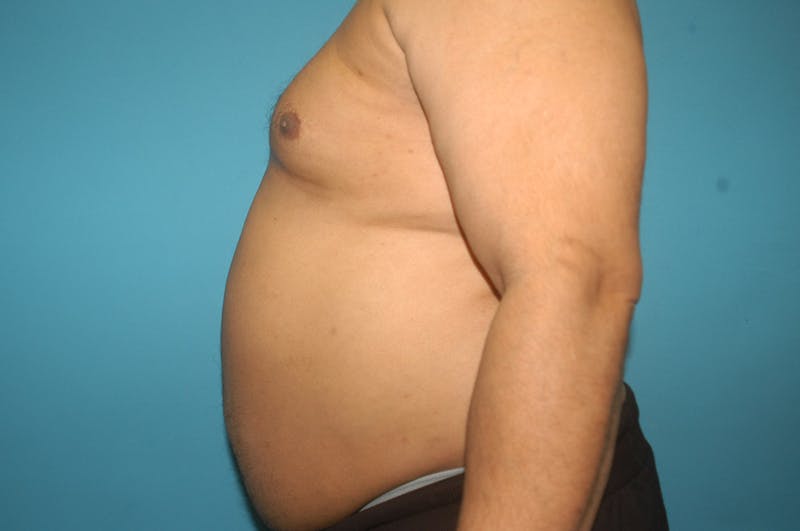 Liposuction Before & After Gallery - Patient 8795248 - Image 5