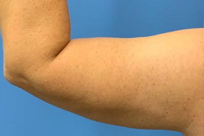 CoolSculpting Before & After Gallery - Patient 8795250 - Image 2