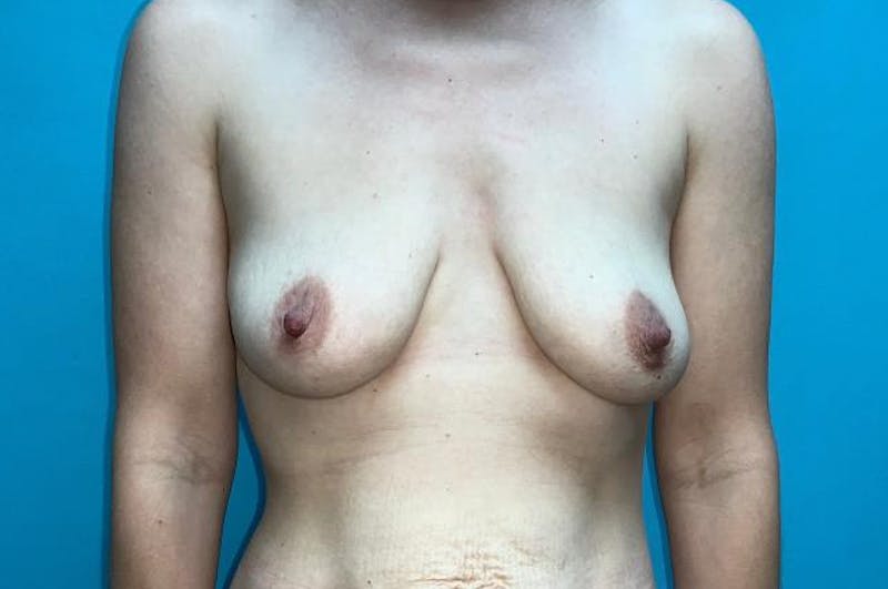 Mastopexy Before & After Gallery - Patient 8795258 - Image 1