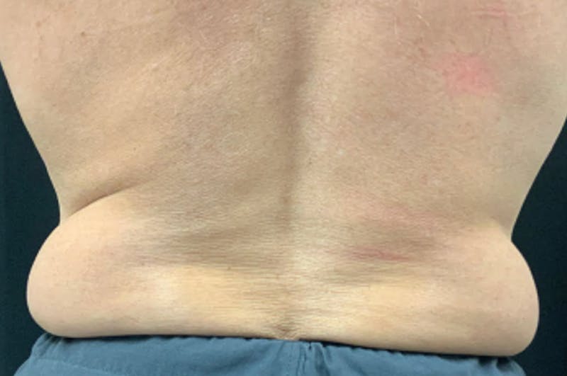 CoolSculpting Before & After Gallery - Patient 8795253 - Image 1