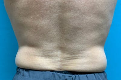 CoolSculpting Before & After Gallery - Patient 8795253 - Image 2