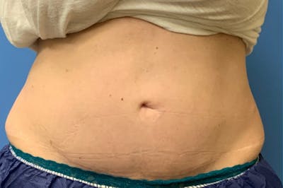 CoolSculpting Before & After Gallery - Patient 8795257 - Image 1