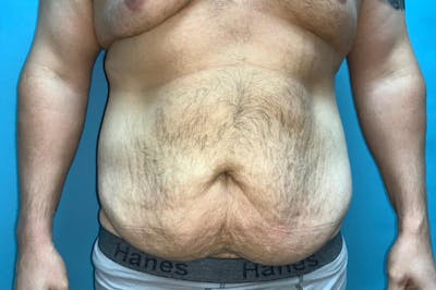 Abdominoplasty Before & After Gallery - Patient 8795284 - Image 1