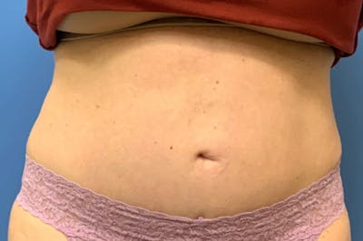 CoolSculpting Before & After Gallery - Patient 8795257 - Image 2