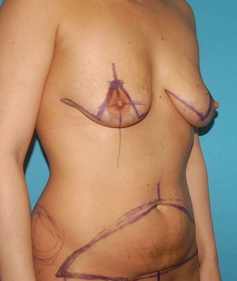 Mommy Makeover Before & After Gallery - Patient 8795282 - Image 3
