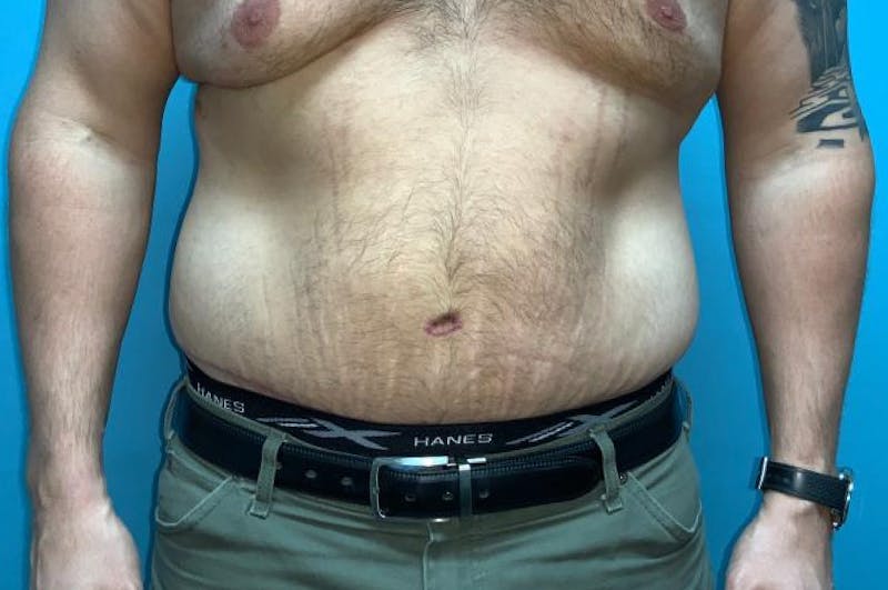 Abdominoplasty Before & After Gallery - Patient 8795284 - Image 2