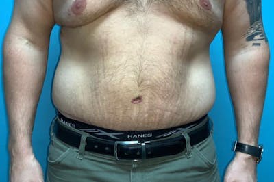 Abdominoplasty Before & After Gallery - Patient 8795284 - Image 2