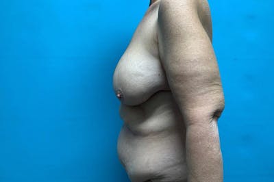 Brachioplasty Before & After Gallery - Patient 8795261 - Image 1