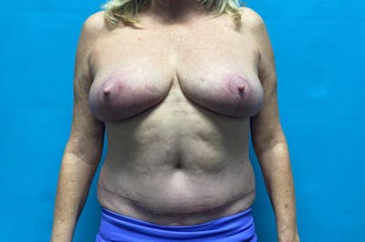 Mastopexy Before & After Gallery - Patient 8795287 - Image 2