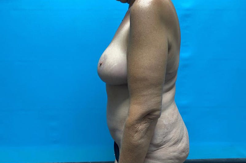 Brachioplasty Before & After Gallery - Patient 8795261 - Image 6