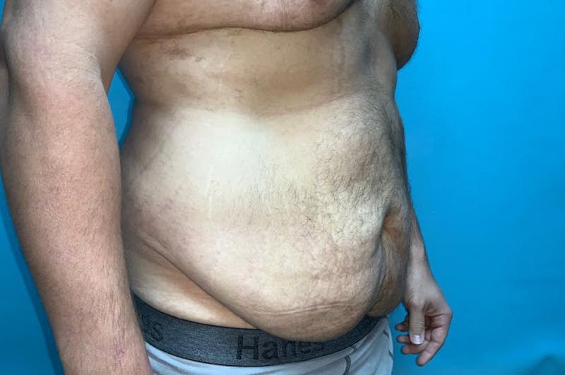 Abdominoplasty Before & After Gallery - Patient 8795284 - Image 3