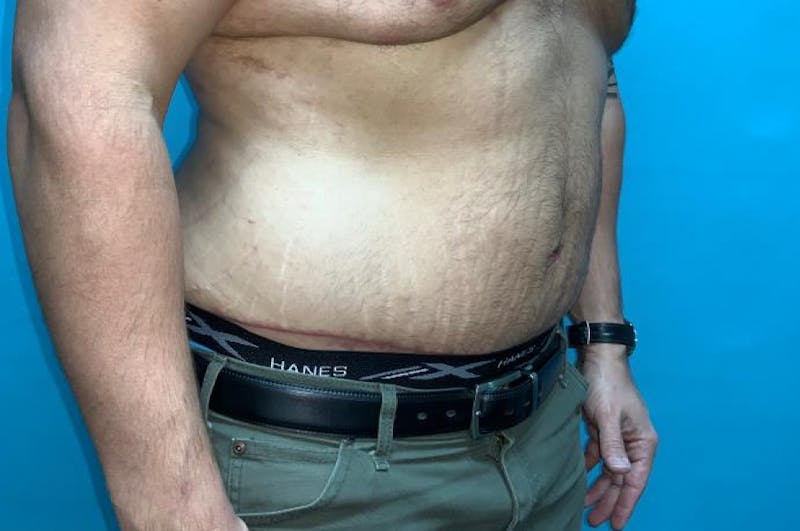 Abdominoplasty Before & After Gallery - Patient 8795284 - Image 4
