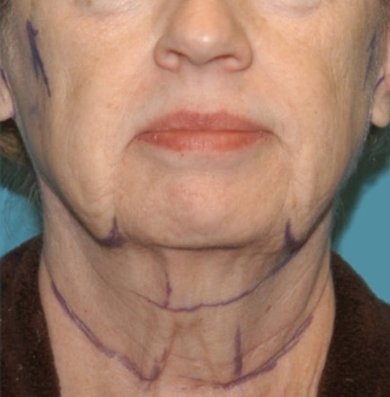 Facelift Before & After Gallery - Patient 8795283 - Image 1