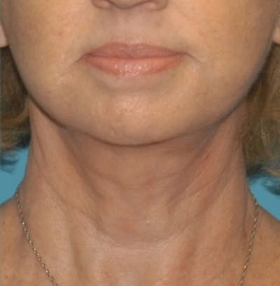 Facelift Before & After Gallery - Patient 8795283 - Image 2