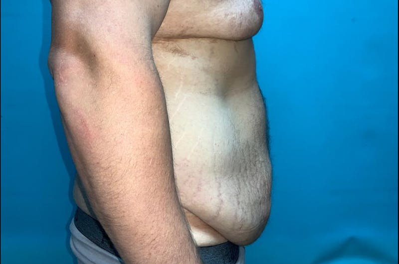 Abdominoplasty Before & After Gallery - Patient 8795284 - Image 5