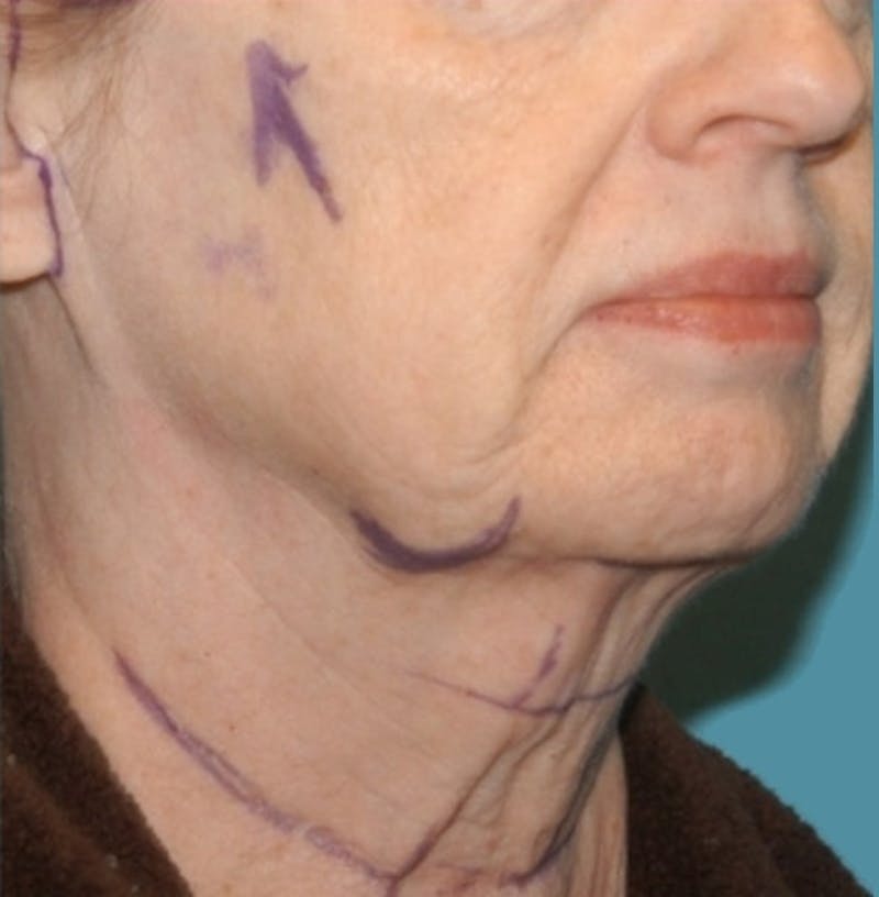 Facelift Before & After Gallery - Patient 8795283 - Image 3