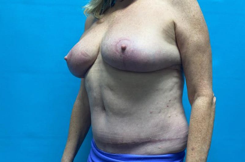 Mastopexy Before & After Gallery - Patient 8795287 - Image 4