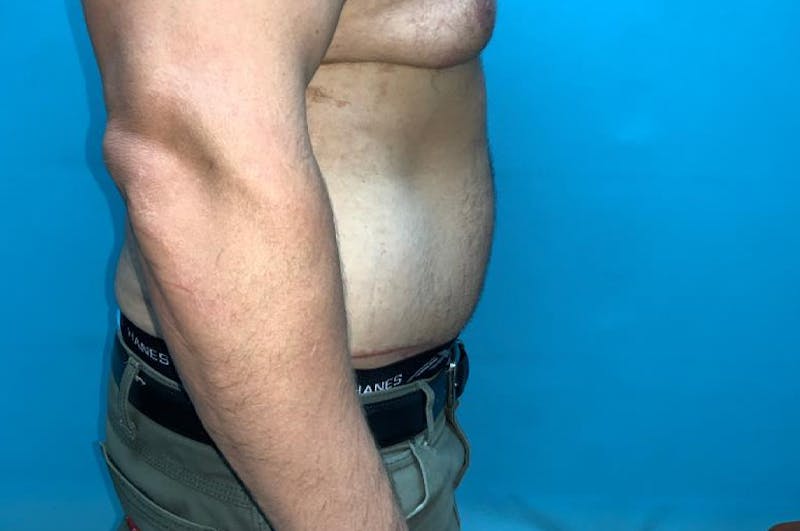 Abdominoplasty Before & After Gallery - Patient 8795284 - Image 6