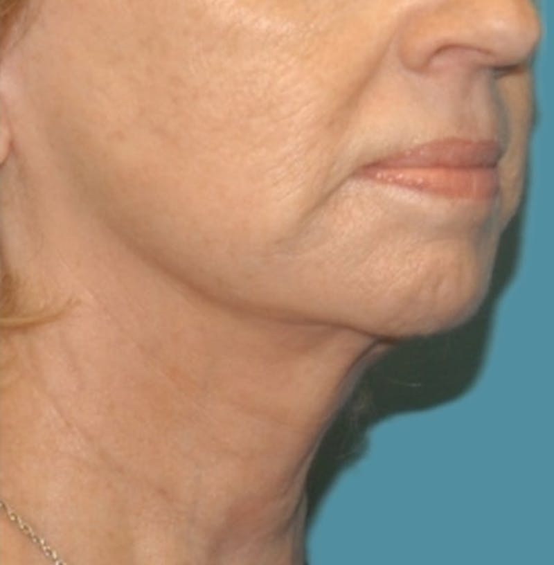 Facelift Before & After Gallery - Patient 8795283 - Image 4