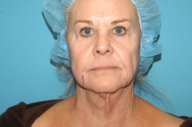 Facelift Before & After Gallery - Patient 8795288 - Image 1