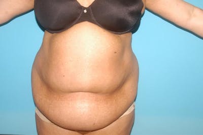 Abdominoplasty Before & After Gallery - Patient 8795289 - Image 1