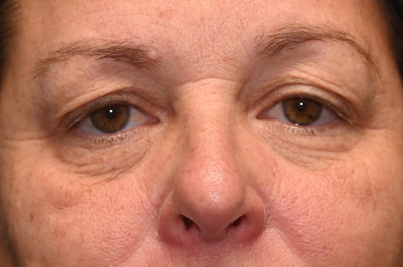 Eyelid Surgery Before & After Gallery - Patient 8795286 - Image 1