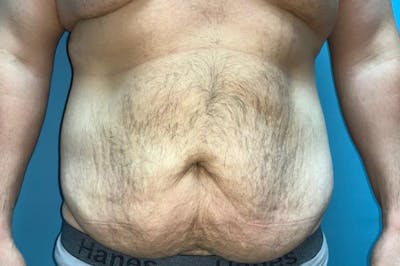 Liposuction Before & After Gallery - Patient 8795310 - Image 1