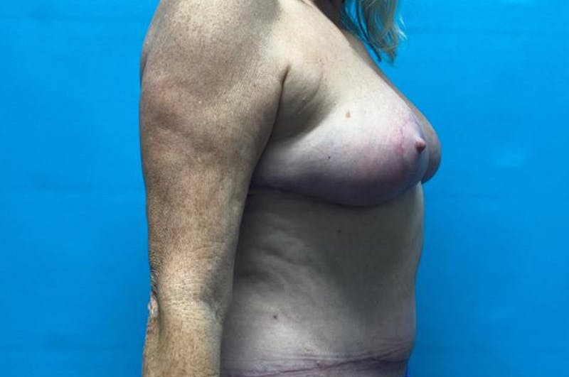 Mastopexy Before & After Gallery - Patient 8795287 - Image 6