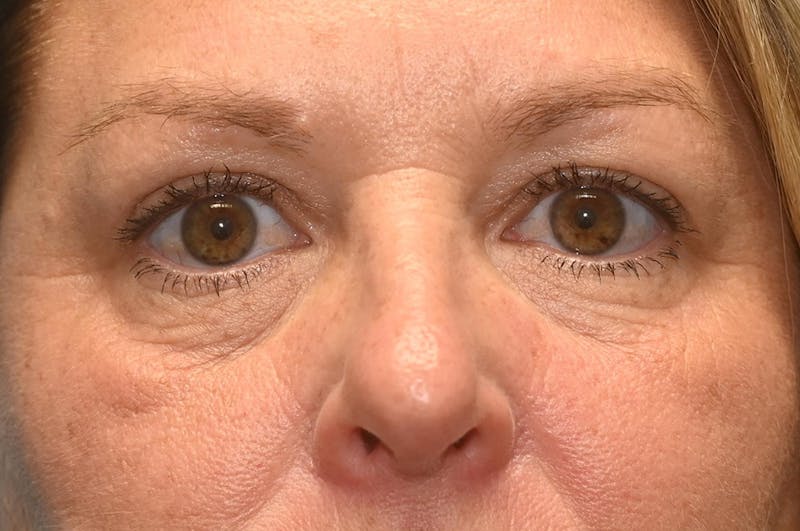 Eyelid Surgery Before & After Gallery - Patient 8795286 - Image 2