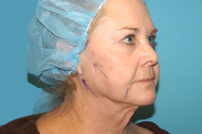 Facelift Before & After Gallery - Patient 8795288 - Image 3