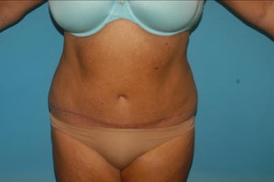 Abdominoplasty Before & After Gallery - Patient 8795289 - Image 2