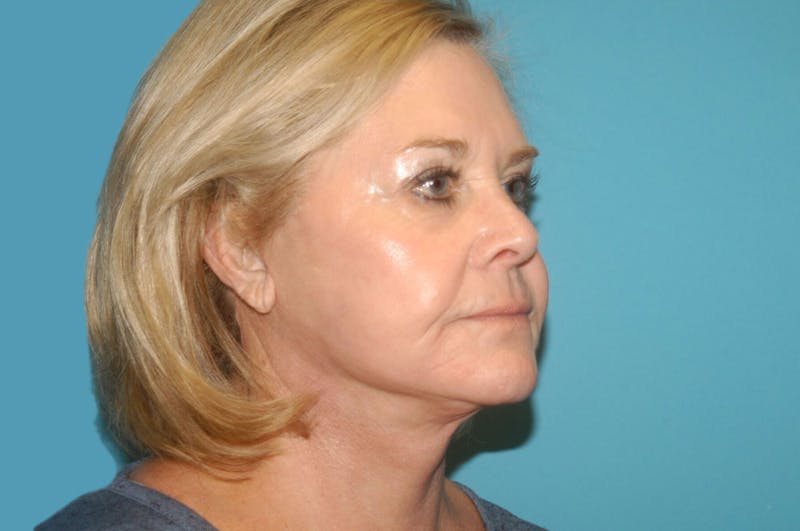 Facelift Before & After Gallery - Patient 8795288 - Image 4