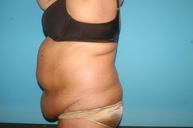 Abdominoplasty Before & After Gallery - Patient 8795289 - Image 3