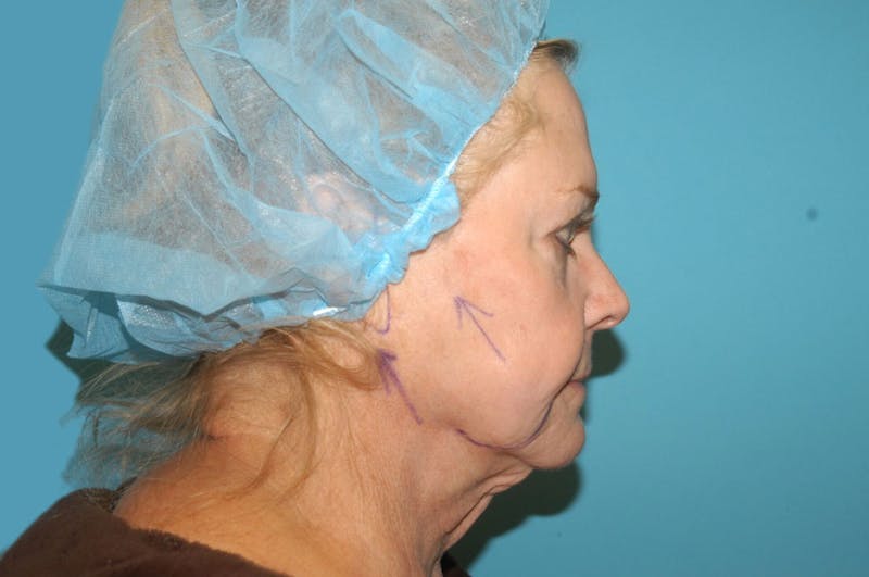 Facelift Before & After Gallery - Patient 8795288 - Image 5