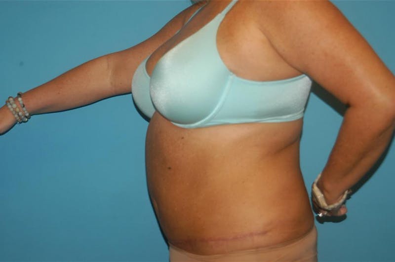 Abdominoplasty Before & After Gallery - Patient 8795289 - Image 4