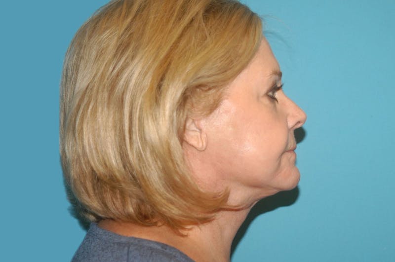 Facelift Before & After Gallery - Patient 8795288 - Image 6