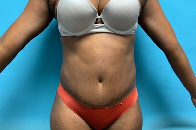 Abdominoplasty Before & After Gallery - Patient 8795314 - Image 2