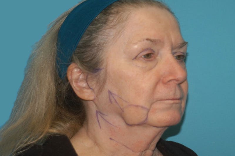 Facelift Before & After Gallery - Patient 8795312 - Image 3