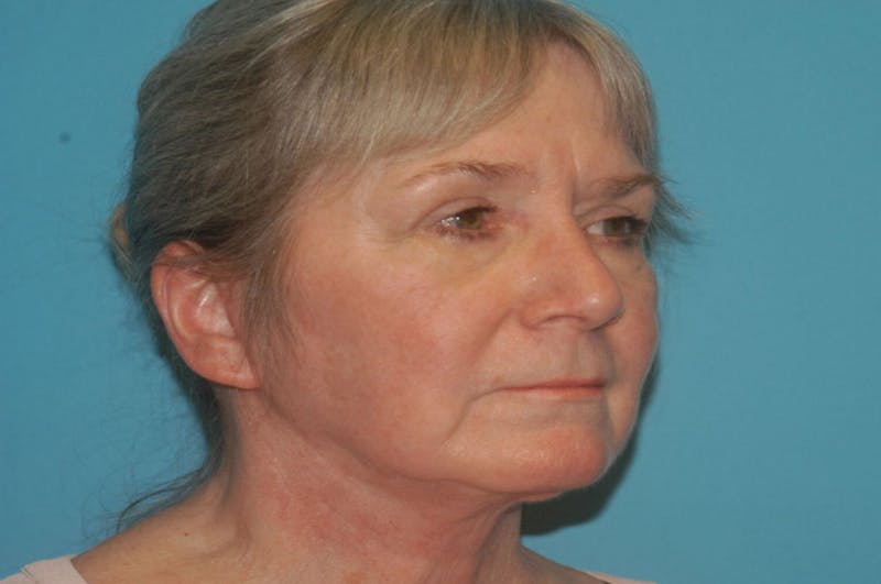 Facelift Before & After Gallery - Patient 8795312 - Image 4