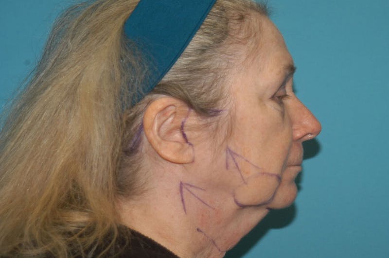 Facelift Before & After Gallery - Patient 8795312 - Image 5