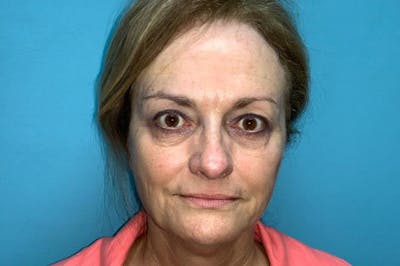 Eyelid Surgery Before & After Gallery - Patient 8795316 - Image 2