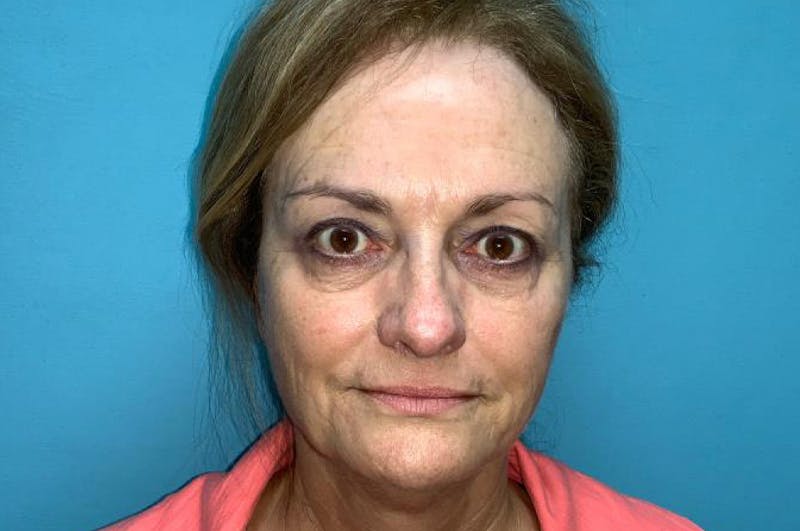Eyelid Surgery Before & After Gallery - Patient 8795316 - Image 2