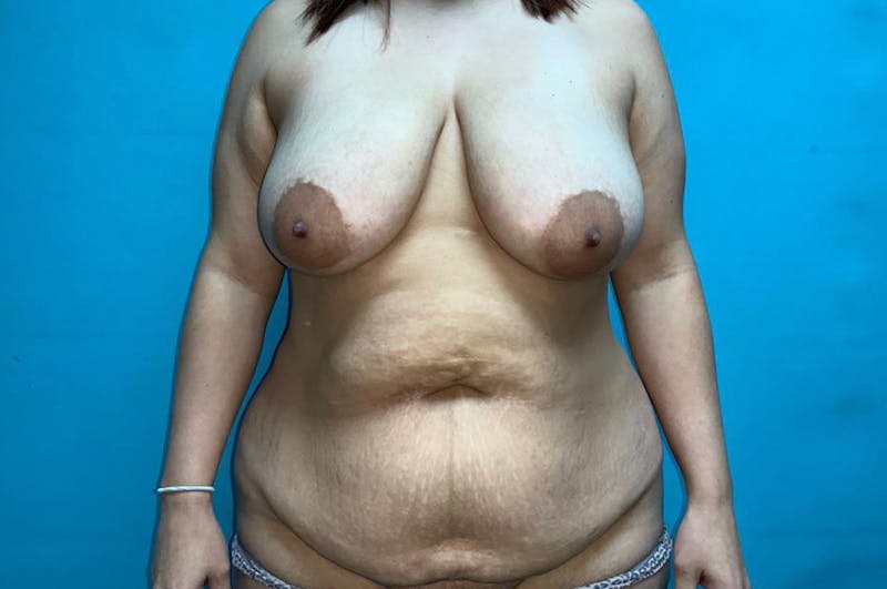 Mastopexy Before & After Gallery - Patient 8795337 - Image 1