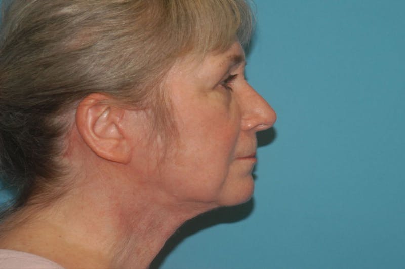 Facelift Before & After Gallery - Patient 8795312 - Image 6