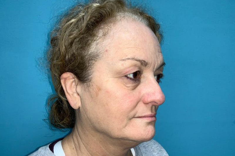Eyelid Surgery Before & After Gallery - Patient 8795316 - Image 3