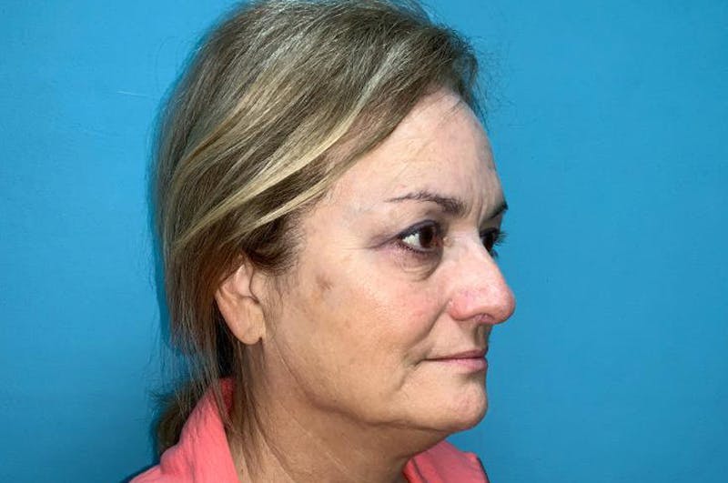 Eyelid Surgery Before & After Gallery - Patient 8795316 - Image 4